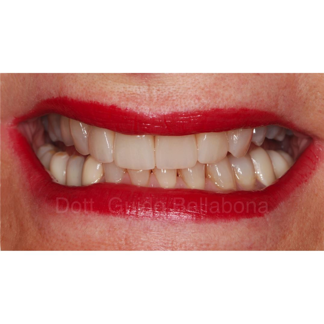 Riabilitazione dei 4 incisivi superiori in zirconia.